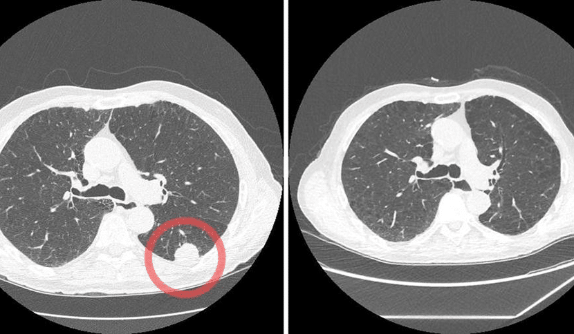 Lung cancer detection with computed tomography (CT scan)