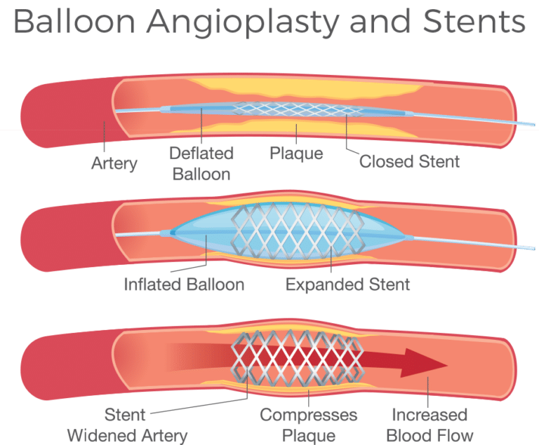 Peripheral Arterial Disease Pad Ara Diagnostic Imaging